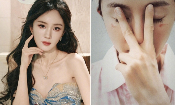 Dương Mịch nghi bị bỏng do mặt nạ mắt hơi nước: Chuyên gia khuyến cáo một điều khi dùng