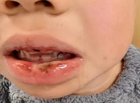 Trẻ uống nhầm dung dịch thông cống: Bác sĩ cảnh báo : Sơ cứu sai còn nguy hiểm hơn