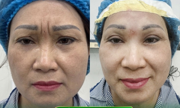 Ths.Bs Phạm Tiến Mạnh với kỹ thuật Utral plus giải pháp cắt triệt cơ cau mày