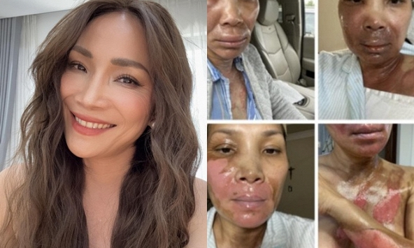 Xót xa nữ nghệ sĩ đình đám bị bỏng nghiêm trọng vì nổ nồi xông hơi: 'Còn sống là hạnh phúc'