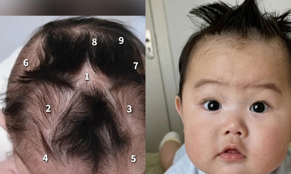 Em bé gây chú ý vì có tới 9 xoáy tóc trên đầu: Liệu có điều gì đặc biệt liên quan đến não bộ của bé?