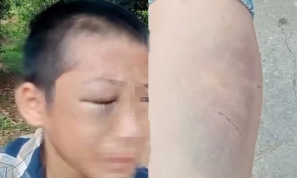 Bé trai nghi bị mẹ kế bạo hành nhiều lần, người bố lên tiếng xin lỗi nhà vợ cũ
