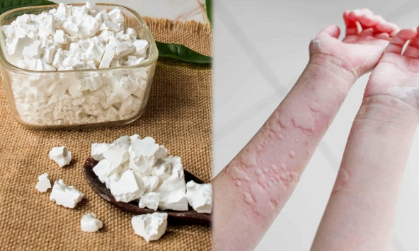 Trong nhà có bột sắn dây: Pha ngay theo cách này để cơ thể THẢI ĐỘC, đánh bay mẩn nNgứa, mề đay mùa nắng nóng
