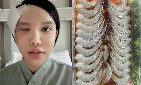 Người phụ nữ bị ký sinh trùng bò vào hốc mắt, suýt mù, bác sĩ cảnh báo 1 thói quen nhiều người Việt mắc phải