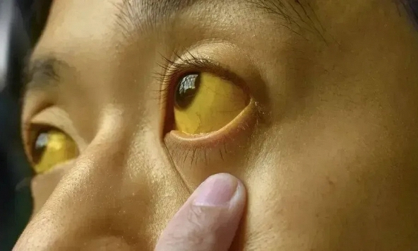 Nếu mắt có 6 thứ, đi khám ung thư ngay còn kịp!