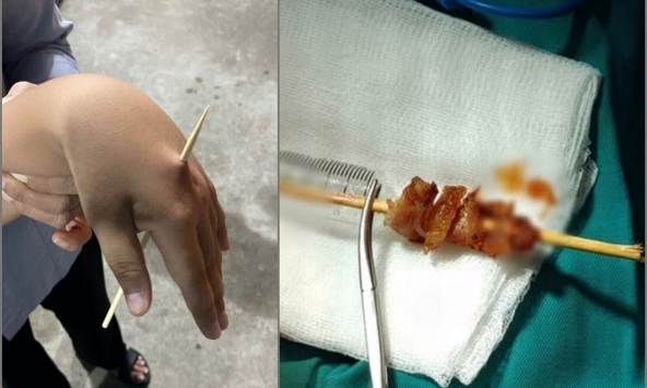 Liên tiếp xảy ra các vụ tai nạn liên quan đến que xiên: Từ bé gái suýt mù mắt đến bé trai bị đâm xuyên bàn tay