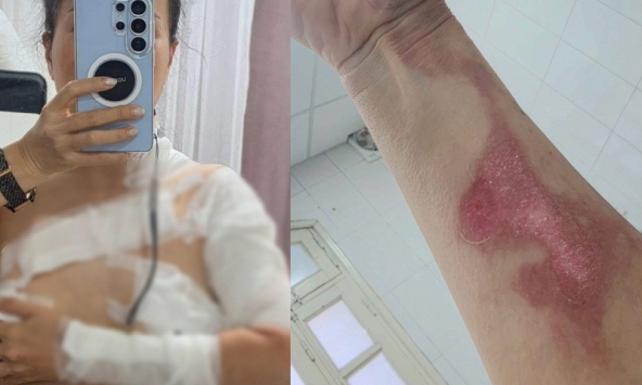 Đi gội đầu dưỡng sinh, cô gái nhận 'combo sự cố': Bỏng độ 2, cấp cứu xuyên đêm vì nồi xông hơi phát nổ?