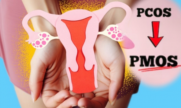 Đổi tên Hội chứng buồng trứng đa nang (PCOS) - tình trạng rất phổ biến ở phụ nữ nhưng bị hiểu nhầm suốt nhiều năm