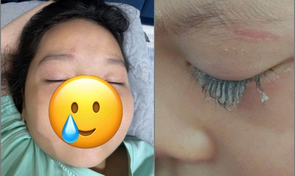 Chỉ 1 phút lơ là mà con gái suýt mù mắt, mẹ bỉm chia sẻ bài học “xương máu” và cách sơ cứu giải nguy trong gang tấc