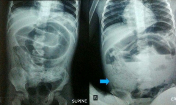 Bé trai đau bụng dữ dội, nôn ói suốt 3 ngày: Bác sĩ mổ khẩn, phát hiện thứ khó tin chặn kín ruột