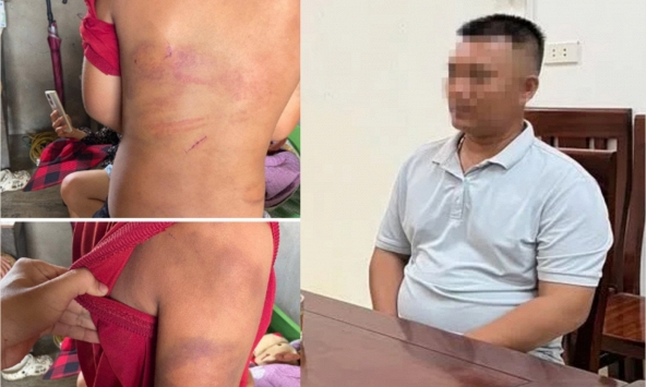 Vụ bé trai 10 tuổi người thâm tím nghi bị bạo hành: Lời khai của bố đẻ