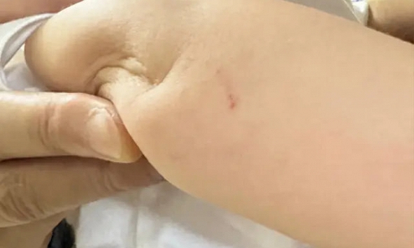 Bé 1 tuổi bị rắn cắn khi chơi trong khu dân cư, bác sĩ cảnh báo nguy cơ dễ bị bỏ sót