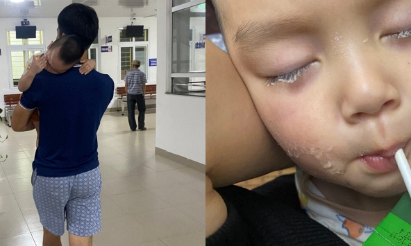 Suýt hối hận cả đời vì vài phút lơ đễnh: Lại thêm 1 em bé bị keo 502 dính vào mắt