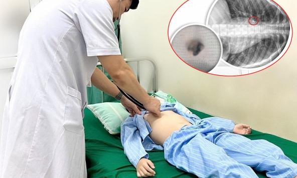 Bé trai 9 tuổi suýt tắc đường thở chỉ vì mẹ tự nhổ răng cho tại nhà
