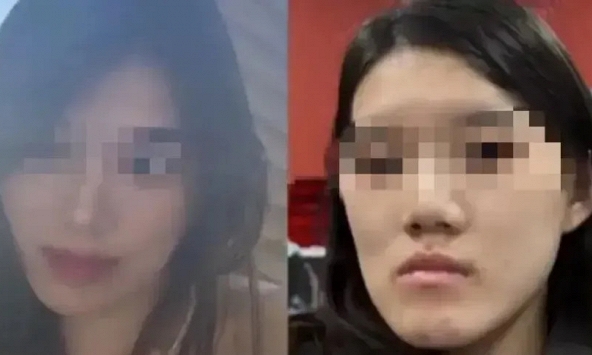 Cô gái bị biến dạng khuôn mặt sau PTTM, bi kịch đau khổ vì quyết định sai lầm