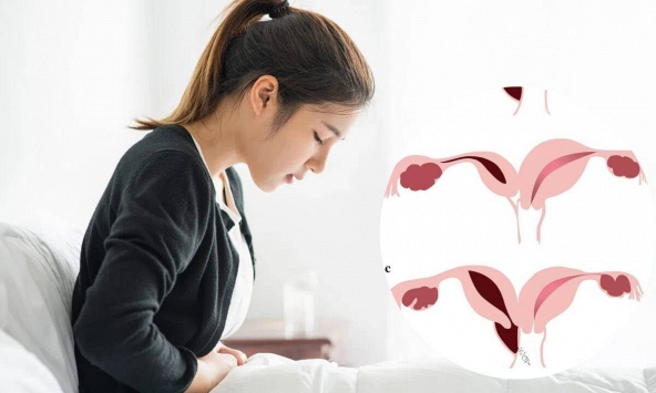Đau bụng kinh suốt nhiều năm, nữ sinh 18 tuổi phát hiện dị tật hiếm: Bác sĩ bất ngờ khi thấy vòi tử cung đã hoại tử