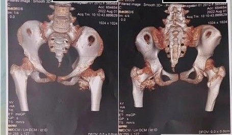 Bé gái 12 tuổi mắc 'hội chứng người hóa đá' hiếm gặp, bố mẹ ngỡ ngàng khi bác sĩ nhắc tới cú ngã xe đạp 2 năm trước