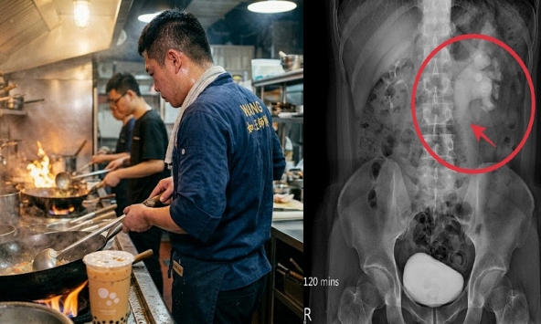 Nam đầu bếp 32 tuổi phù thận cấp tính vì 1 thói quen uống nước không ít người vẫn làm mỗi ngày