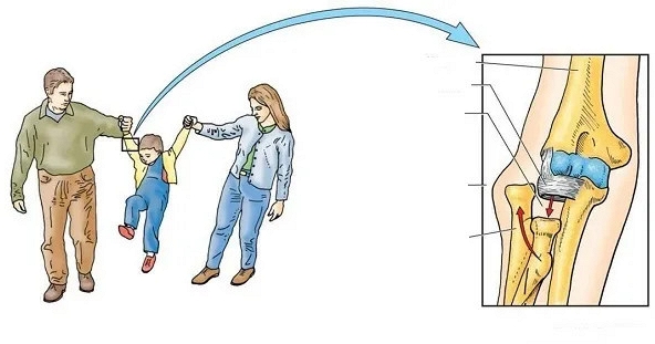 Bác sĩ cảnh báo: Kéo tay con kiểu này, chỉ cần 1 cái cũng có thể khiến trẻ bị trật khớp khuỷu tay