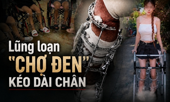Điều tra: Bên trong 'chợ đen' phẫu thuật tăng chiều cao, hơn 1,5 tỷ đồng đổi lấy từng milimét và những ca mổ không lộ mặt bác sĩ