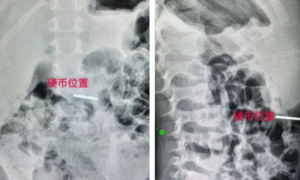 Con nuốt phải tiền xu, mẹ tuyệt đối đừng móc họng! Hãy thuộc lòng ngay quy trình 'giải cứu' sau đây