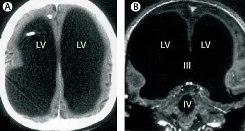 1 người đàn ông 44 tuổi mất tới 90% não bộ nhưng vẫn sống và làm việc bình thường: Chuyện gì đã xảy ra?