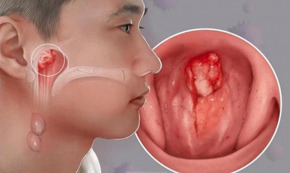 Con bị ù tai thôi mà... và cú sốc của gia đình khi bé trai 14 tuổi được chẩn đoán ung thư giai đoạn tiến triển