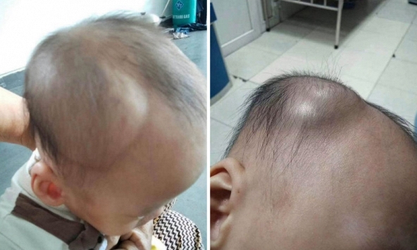 Một mẹ bỉm chia sẻ diễn biến âm thầm nhưng nguy hiểm sau cú ngã của con: Đừng chủ quan kể cả khi bé có vẻ vẫn bình thường