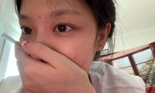 4 bất thường ở vùng đầu cảnh báo tế bào ung thư đang 'gặm nhấm' phổi