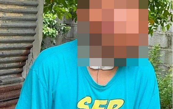 Người đàn ông 31 tuổi biến dạng khuôn mặt đến khó tin sau thời gian thường xuyên dùng tăm xỉa răng