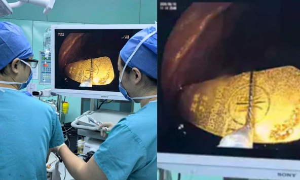 Bé gái 5 tuổi nuốt thỏi vàng 50gr, các bác sĩ nội soi gắp thành công