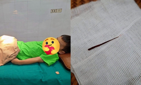 Con trai chịu đau cả buổi chiều không dám báo cô: Bố mẹ đưa đi viện mới lo lắng với chiếc dằm rút ra từ đùi con