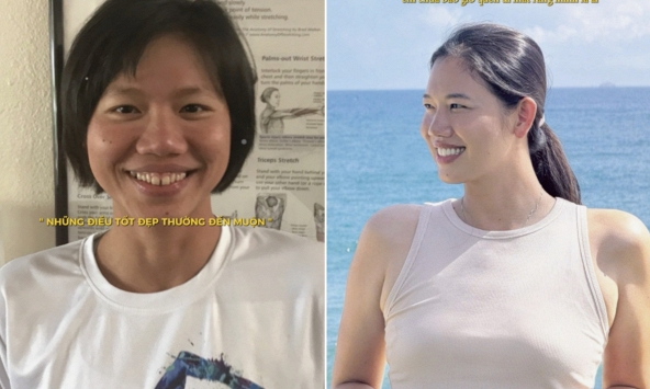 Ánh Viên trước và sau khi niềng răng