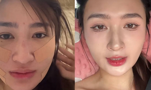 Mỹ nhân SN 2001 đóng phim giờ vàng VTV công khai dung mạo sau khi hút mỡ mặt