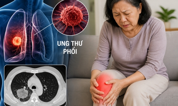 Bác sĩ cảnh báo: 3 DẤU HIỆU quan trọng của ung thư phổi, nhiều người chủ quan vì nghĩ đau chân do thời tiết