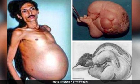 Người đàn ông 60 tuổi 'mang thai' suốt 36 năm, nhóm bác sĩ kinh hoàng khi tiến hành phẫu thuật