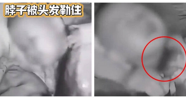 Bé trai 2 tuổi suýt chết vì bị tóc dài của mẹ thắt cổ trong lúc ngủ
