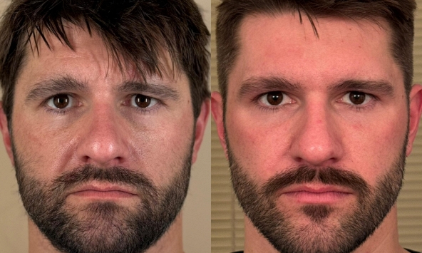 Xu hướng 'đàn ông cũng đi thẩm mỹ': Không lố, chỉ cần gọn, tươi và lên hình tốt