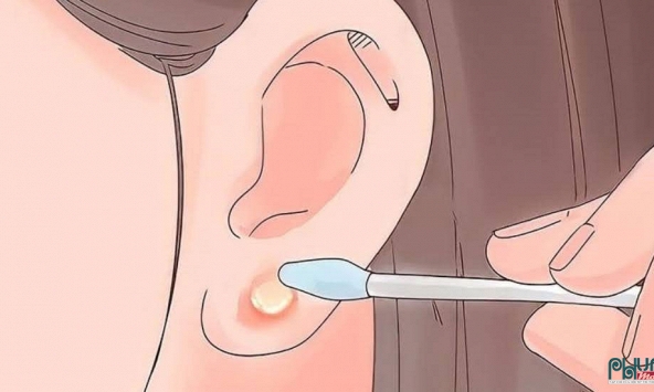 Cách chữa bấm lỗ tai bị mưng mủ tại nhà hiệu quả, an toàn