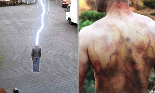 Người đàn ông sống sót sau 4 lần bị sét đánh, kể lại điều thực sự xảy ra với cơ thể mình