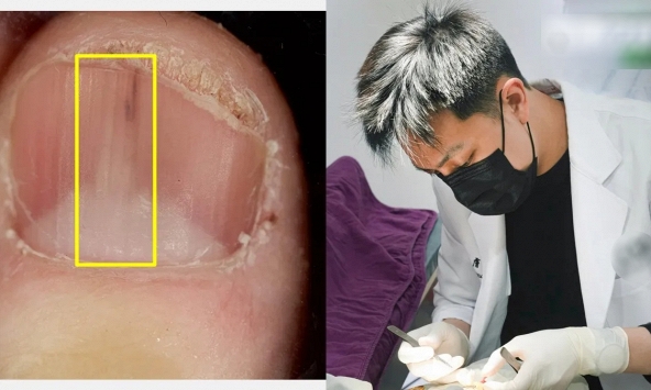 Người phụ nữ 45 tuổi phát hiện khối u từ 1 dấu hiệu ở móng tay nhiều người bỏ qua