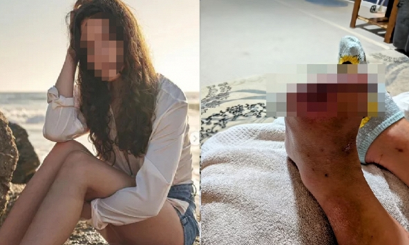 Cô gái 20 tuổi hoại tử, phải cắt bỏ 2 ngón chân vì mỗi ngày đều uống 1 loại nước 'vạn người thích'