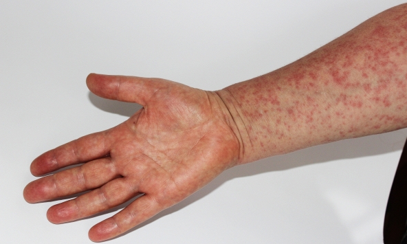 Dịch sởi lan rộng khiến hàng chục trẻ em tử vong, một quốc gia triển khai chiến dịch tiêm chủng khẩn cấp