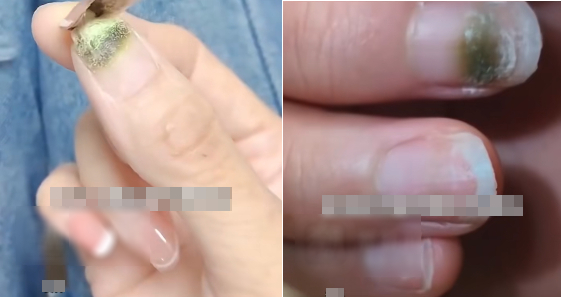 Người phụ nữ bị mốc móng tay sau khi làm nails, bác sĩ lên tiếng cảnh báo