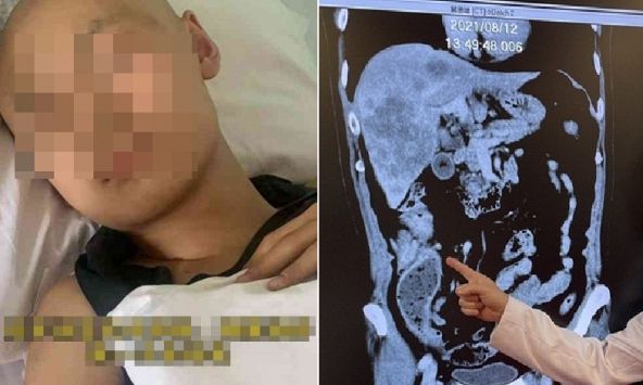 Thiếu niên 18 tuổi mắc ung thư đại trực tràng giai đoạn 3, bác sĩ nhắc: Người trẻ thường bỏ qua 2 dấu hiệu cảnh báo