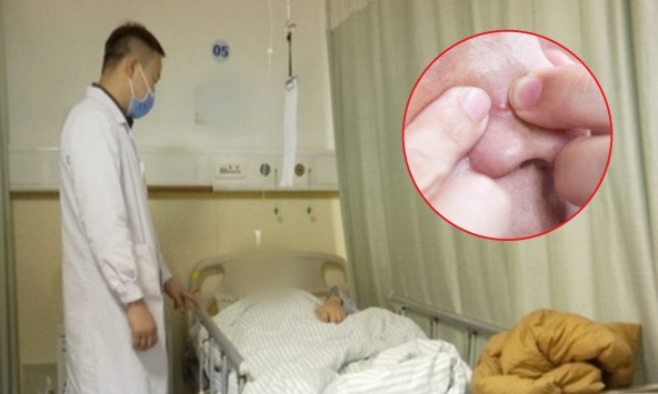 Nặn mụn trên mặt, người đàn ông 51 tuổi phát triển khối u ác tính