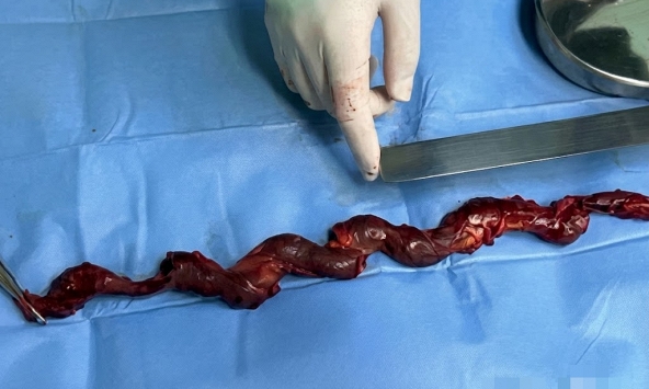 SK check: Lấy ra cục máu đông khổng lồ 40cm từ người đàn ông 10 năm vẫn cố chấp làm 1 việc