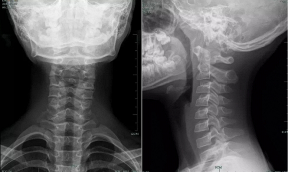 10 tuổi cột sống cổ đã cong vẹo, không cử động được vì thói quen của nhiều người