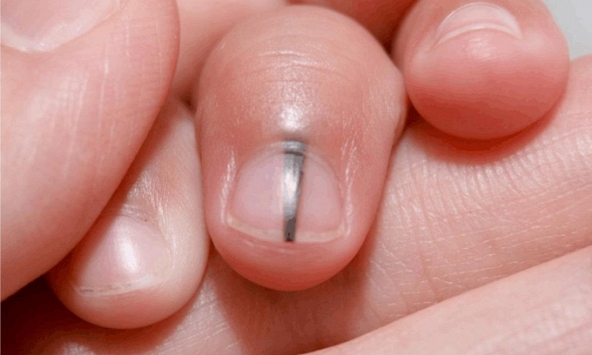 6 dấu hiệu cảnh báo trước khi ung thư ập đến, ít ai chú ý tới