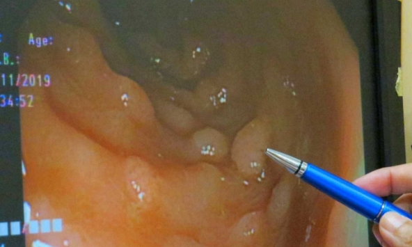 Polyp ở 3 vùng dễ dẫn đến ung thư, 5 thói quen tốt cần làm để tránh